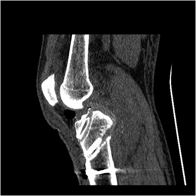 Knee Dislocation ACL PCL Reconstruction